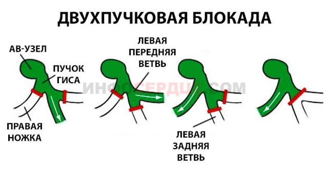 Блокада левой ножки пучка Гиса на ЭКГ (полная и неполная)
