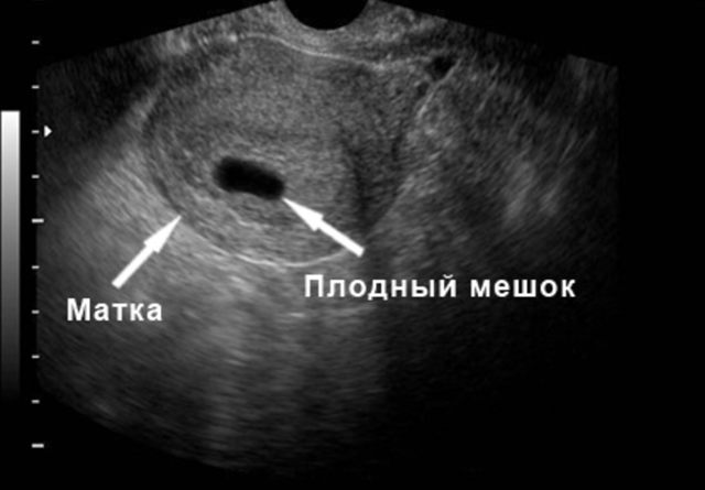 Может ли УЗИ не увидеть беременность, почему не видно плодного яйца (эмбриона)