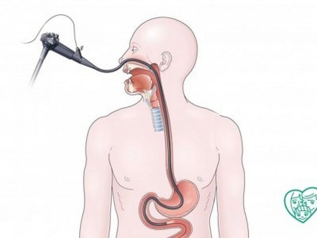 Гастроскопия через нос (назальная, трансназальная, интраназальная), отзывы