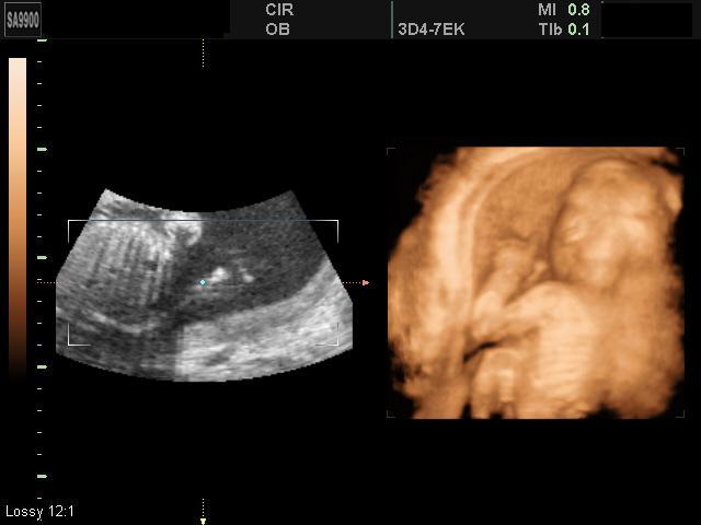 Второе УЗИ при беременности (2 триместр): что смотрят, скрининг плода