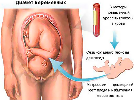 Норма сахара в крови у беременных, таблица нормального уровня глюкозы при беременности