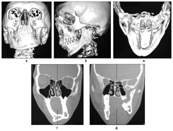 Компьютерная томография челюсти (верхней или нижней)