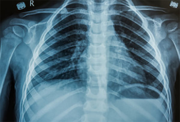 Рентген грудной клетки ребенку, как делают детскую рентгенографию с фиксацией
