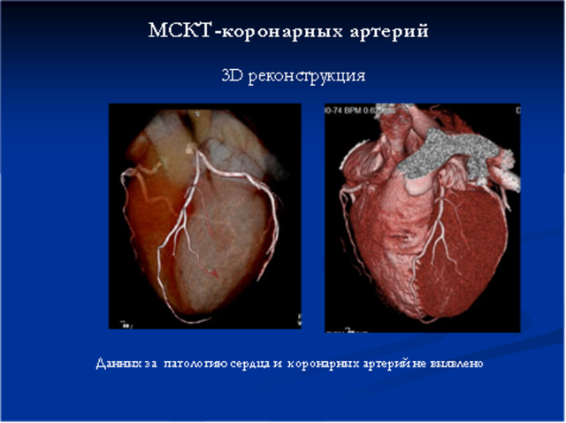 МРТ сердца и коронарных сосудов: что показывает, как делают, показания
