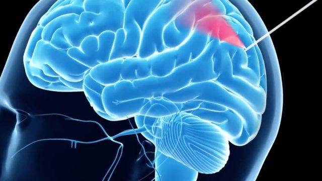 Биопсия головного мозга: показания к операции, методика выполнения