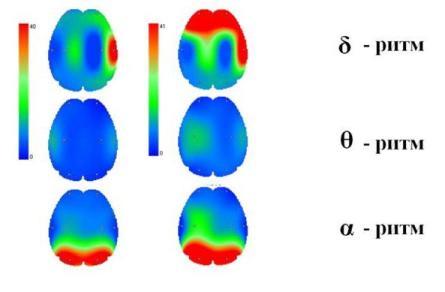 Расшифровка показателей ЭЭГ головного мозга, заключения энцефалограммы у взрослых