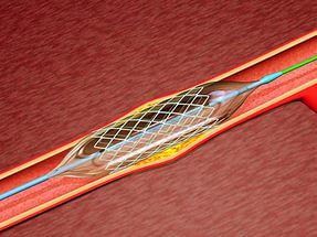 Ангиография сосудов нижних конечностей: как проводится исследование артерий