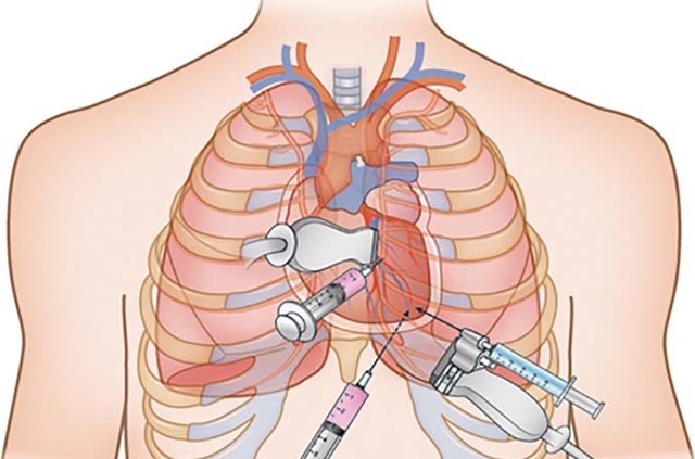 Гипертрофия левого желудочка сердца на ЭКГ: признаки, виды, причины