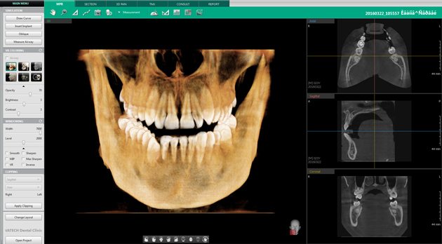 Компьютерная томография зубов и челюсти, что такое 3d-томография