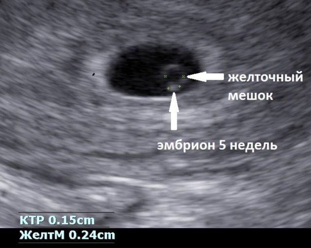 УЗИ на 5 неделе беременности: фото, можно ли делать, что покажет, размеры плода