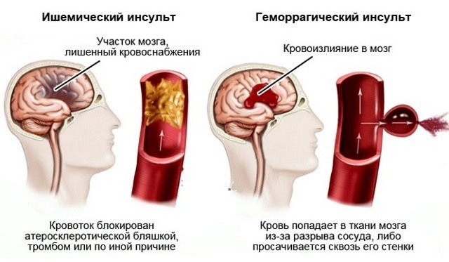 МРТ сосудов головного мозга: что это такое, что показывает, чем отличается