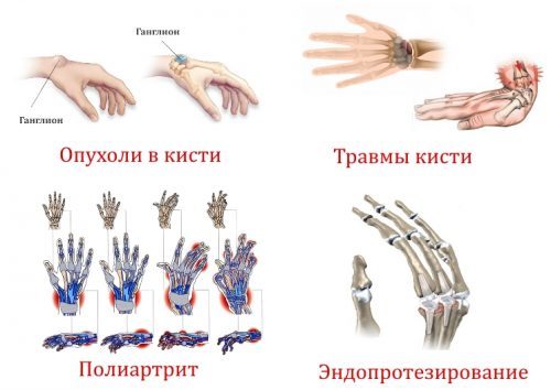 Рентген руки (кисти, запястья, предплечья и фаланг пальцев)