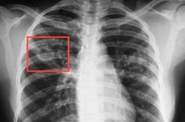 Рентген легких ребенку: показания к детской цифровой рентгенографии, подготовка