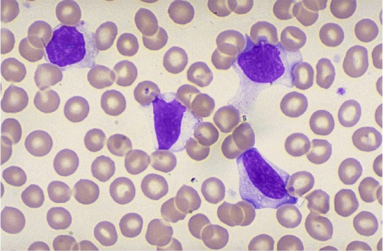 Атипичные мононуклеары в крови у ребенка или взрослого: норма в общем анализе, что значат