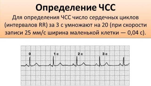 Расшифровка ЭКГ у взрослых: норма кардиограммы сердца, таблица показателей, фото