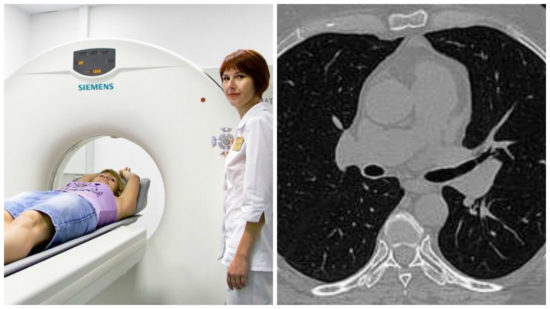 Компьютерная томография органов грудной клетки, что она показывает
