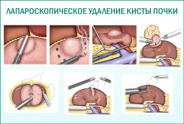 Лапароскопия почки (кисты): подготовка к процедуре, преимущества метода