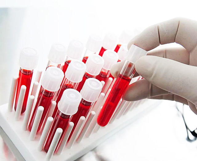 Анализ крови на антитела к кори: как сдавать, расшифровка