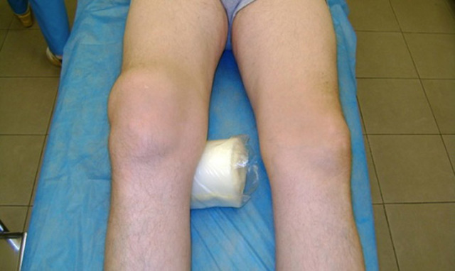 Рентген коленного сустава, что показывает рентгенография колена