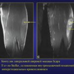 МРТ ног и стоп, что показывает обследование вен нижних конечностей