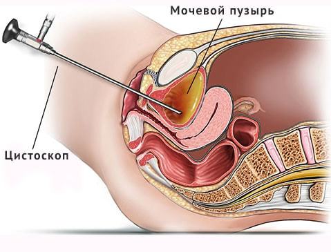 Цистоскопия мочевого пузыря: что это такое, отзывы, как делают, подготовка и показания