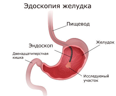 Эндоскопия желудка: что такое эндоскопическое исследование, показания, подготовка