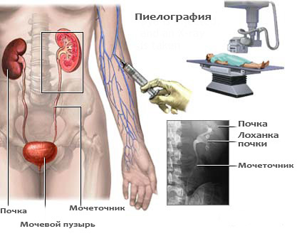 Антеградная пиелография: рентген почек с контрастом (контрастным веществом), подготовка