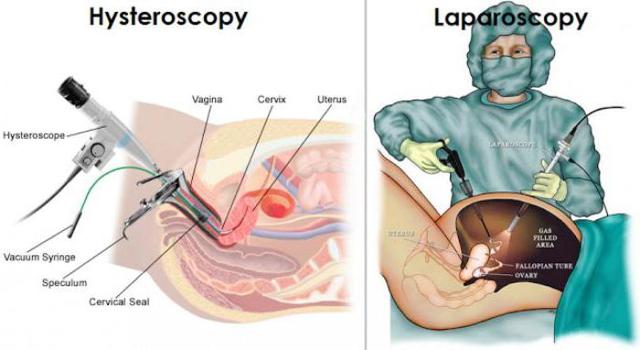 Лапароскопия и гистероскопия одновременно, отзывы о процедурах