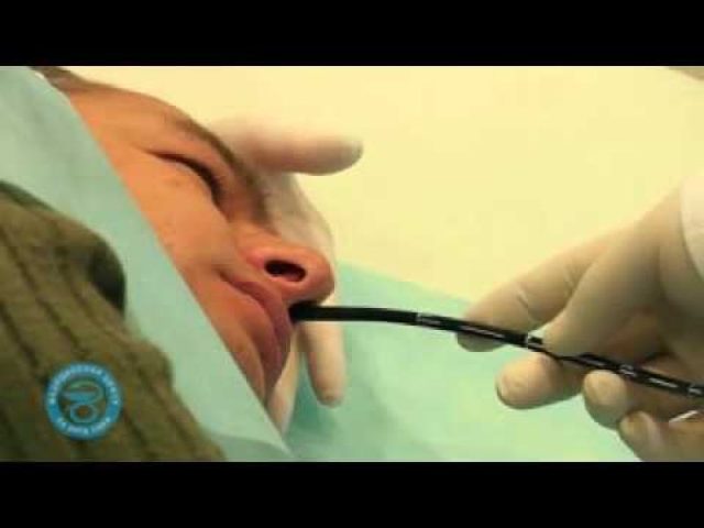 Гастроскопия через нос (назальная, трансназальная, интраназальная), отзывы
