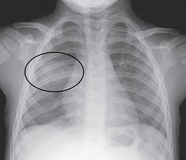 Рентген органов грудной клетки: что показывает рентгенография, как часто можно делать