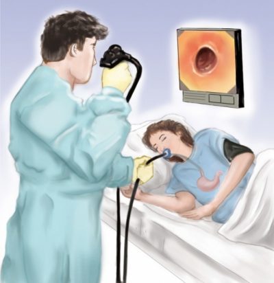 Диета перед гастроскопией желудка: важные приготовления, особенности