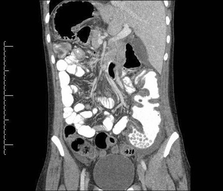 Компьютерная томография органов брюшной полости, что показывает процедура КТ