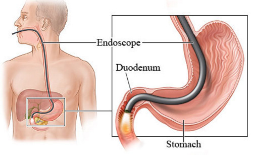 Эндоскопия желудка: что такое эндоскопическое исследование, показания, подготовка