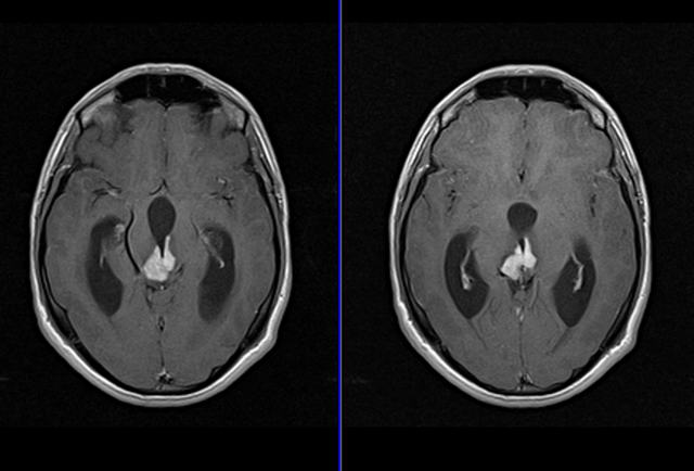 КТ и МРТ головного мозга: чем отличается, что лучше и информативнее