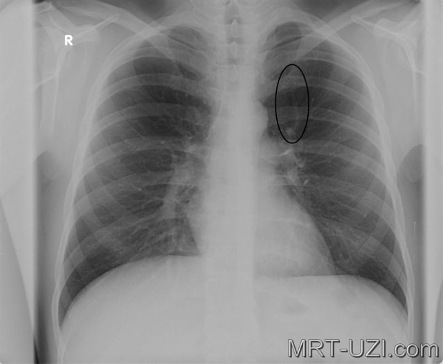 Рентген органов грудной клетки: что показывает рентгенография, как часто можно делать