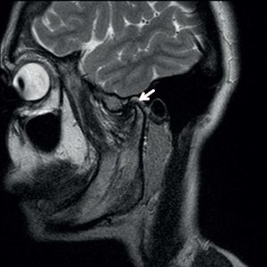 МРТ ВНЧС, головного мозга коронки, челюстно-лицевого сустава, что показывает