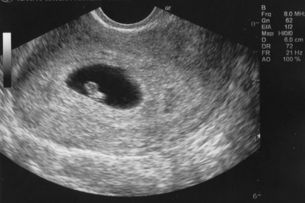 УЗИ на 6 неделе беременности: размеры плода, фото, можно ли делать диагностику