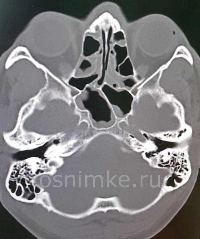 Компьютерная томография пазух носа (придаточных, околоносовых)