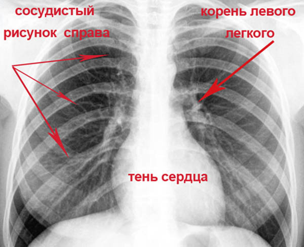 Рентген легких: что показывает рентгенография, как часто можно делать рентогеноскопию