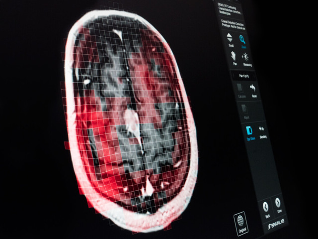 Можно ли делать МРТ с металлокерамическими коронками (головного мозга, др.)