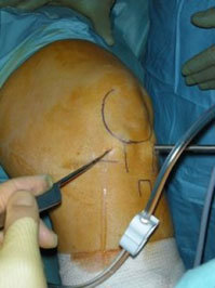 Артроскопия мениска коленного сустава: показания и проведение