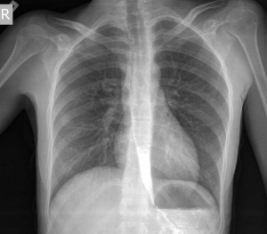 Рентген кишечника, желудка и пищевода: что показывает рентгеноскопия, как ее делают