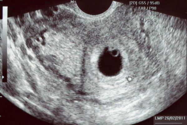 Может ли УЗИ не увидеть беременность, почему не видно плодного яйца (эмбриона)