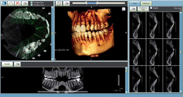 Компьютерная томография зубов (дентальная): показания, подготовка
