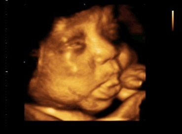 3Д УЗИ при беременности в 20 недель, фото и видео плода