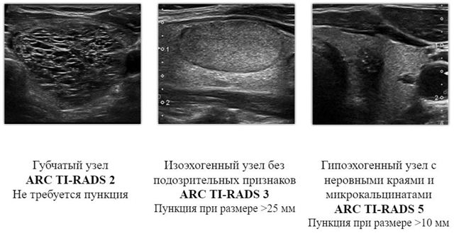 Пункция щитовидной железы под контролем УЗИ (пункционная биопсия узла)
