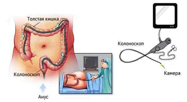 Эндоскопия кишечника: что это такое, подготовка к эндоскопическому исследованию прямой кишки