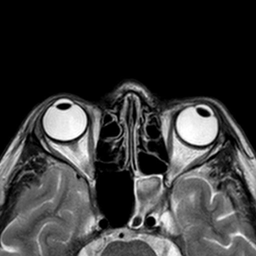 МРТ глаза (глазных орбит и зрительных нервов), что показывает