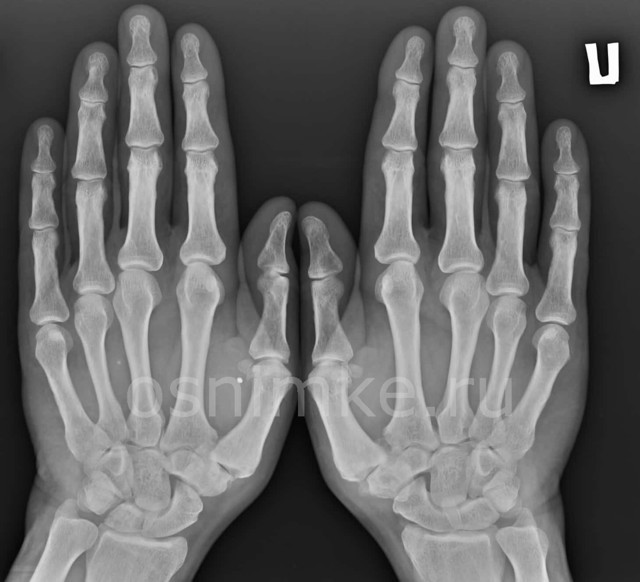 Рентген руки (кисти, запястья, предплечья и фаланг пальцев)