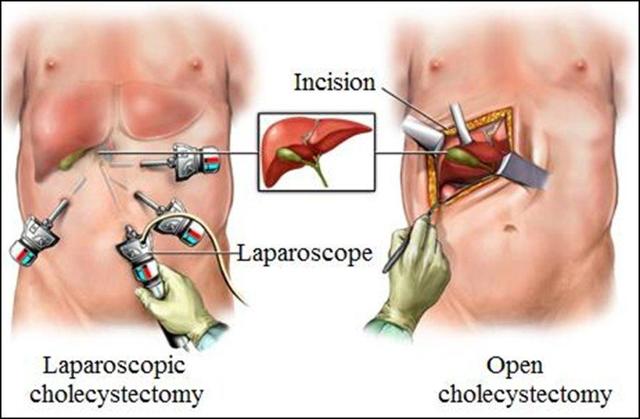 Лапароскопия аппендицита (операция по удалению аппендикса)